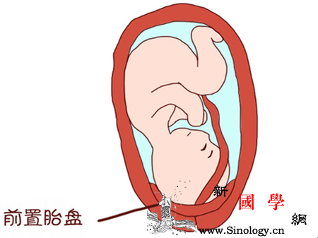 前置胎盘能长上去吗_胎盘-卧床-休克-妊娠-