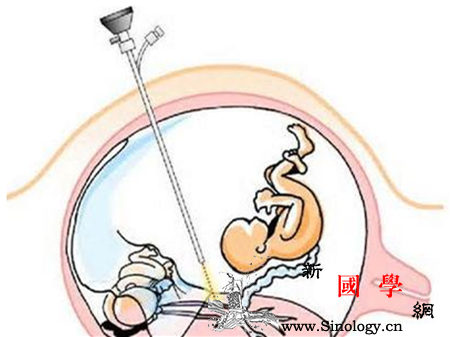 羊膜腔灌注法多少钱_羊膜-生理盐水-羊水-灌注-