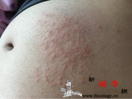 孕妇皮肤出现湿疹是什么原因_静脉曲张-孕期-湿疹-孕妇-