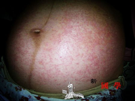 孕妇湿疹多久可以好_烫洗-患处-湿疹-孕妇-