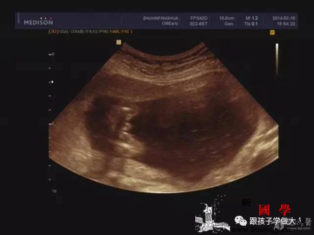 羊水出现这个问题可能导致胎儿窒息准妈一定要_羊水-浑浊-缺氧-胎儿-