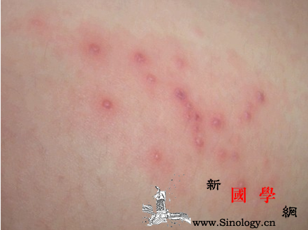孕妇湿疹是什么样的_肘窝-鳞屑-丘疹-结痂-