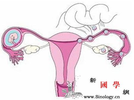 宫外孕的类型_停经-宫外孕-输卵管-宫颈-