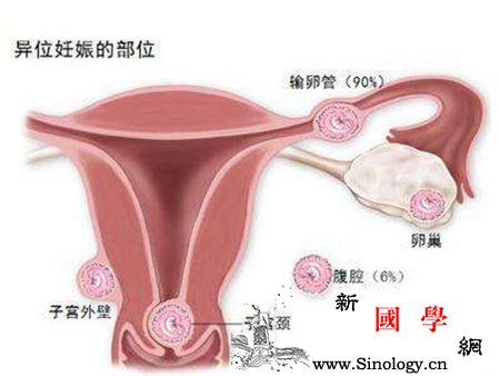 宫外孕概率有多大_受精卵-宫外孕-输卵管-妊娠-