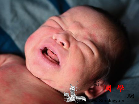 孕妇湿疹是胎毒吗_胎毒-疥癣-啼叫-炎症-