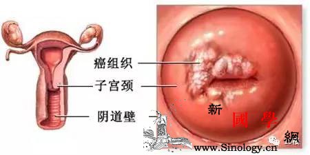 准妈妈怀孕18周却突然来了“月经”一查竟然_宫颈癌-妊娠-怀孕-女士-