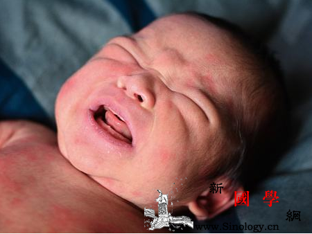 胎毒是什么_胎毒-豆类-哭闹-西医-