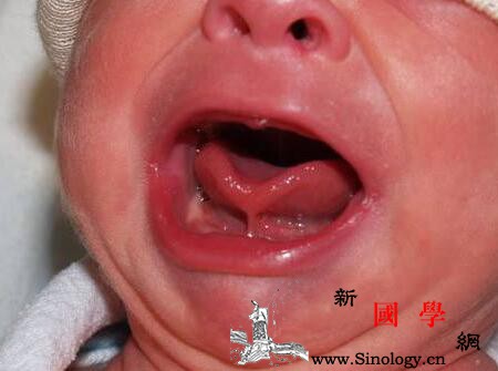宝宝舌系带短的误区有哪些孩子舌系带短的三个_舌系带-舌尖-误区-手术-