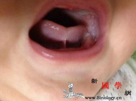 宝宝舌系带短的危害舌带系短的危害有哪些_舌系带-致使-舌头-卷舌音-