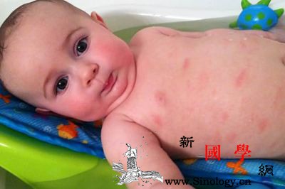 湿疹宝宝可以打疫苗吗宝宝接种疫苗这些事情要_脊髓灰质炎-接种-湿疹-疫苗-