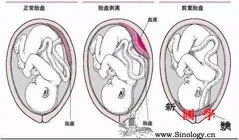 胎儿在胎盘的前壁和后壁有区别吗？_滑脱-胎盘-附着-妊娠-