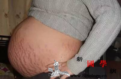 妊娠纹？产前如何预防产后做好修复_产前-孕期-产后-腹部-