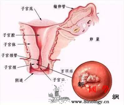 宫颈癌治疗方法的选择手术？放疗？_宫颈癌-化疗-肿瘤-患者-