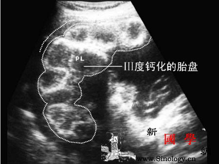 胎盘老化是什么意思_钙化-胎盘-成熟度-减退-
