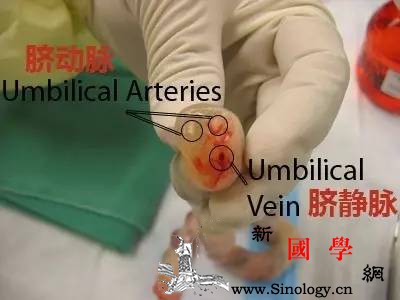 我也没有多调皮不过是脐带绕了65圈而已_脐带-缠绕-足月-医生-