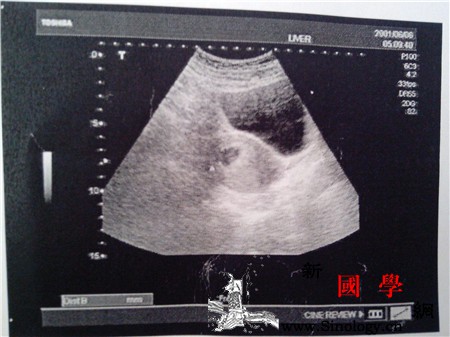 孕6周b超能看到孕囊吗_羊膜-酮体-胎盘-超能-