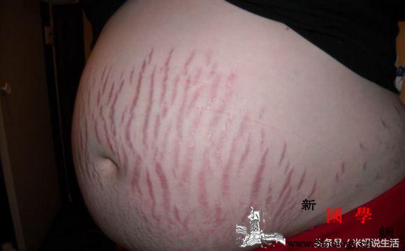 孕前孕后孕妈多做这7件小事轻松告别妊娠纹_腹部-孕妇-皮肤-妊娠纹-