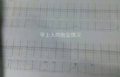 别把胎心监测不当“检查”！_基线-监护-胎儿-减速-