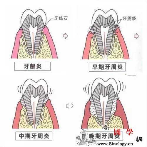 怀孕之前口腔问题一定要及时解决哦_蛀牙-牙龈-孕期-牙齿-
