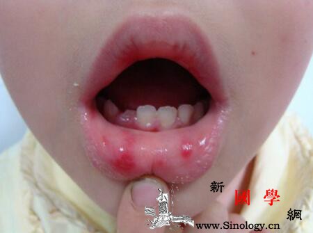 宝宝缺维生素b的症状有哪些几个信号透露出小_维生素-症状-口角炎-几个-