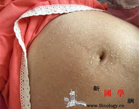 孕妇肚皮起皮怎么办肚皮起皮竟和这些有关_孕期-缺水-肚皮-孕妇-