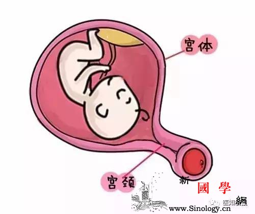 准妈妈有早产征兆该如何保胎？这种情况要尽早手_宫颈-机能-准妈妈-手术-