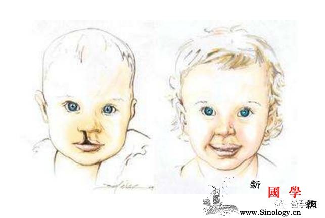 怀孕6个月查出胎儿唇腭裂孕早期一定要注意！_唇裂-兔唇-孕期-胎儿-