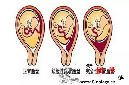 胎盘前置会引起妊娠后期的出血症状？_胎盘-妊娠-胎儿-阴道-