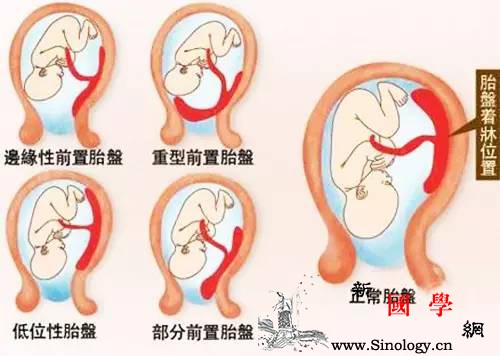 孕期胎盘低？你知道该如何“涨上去”吗？_胎盘-休息-宝宝-会有-