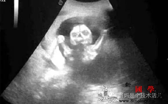 B超对胎儿绝对安全吗？最不稳定的孕早期能做B_胎盘-胚胎-妊娠-胎儿-