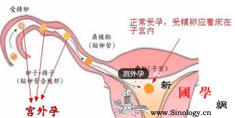 宫外孕特征有哪些患者有什么表现_宫外孕-还会-胚胎-症状-