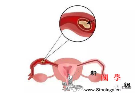 怀孕乱吃事后药想流产输卵管破裂出血险丧命_宫外孕-输卵管-破裂-服用-