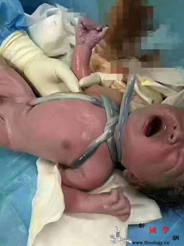 宝宝用脐带把自己花式捆绑起来连医生都吓了一_试产-胎动-脐带-胎儿-