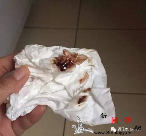 孕期分泌物如果出现这种异常要当心可能是胎儿_分泌物-胎儿-褐色-出血-