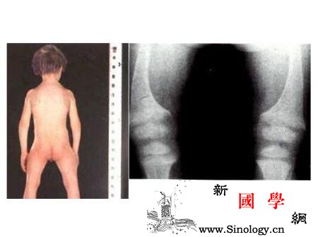 小儿骨硬化病治疗方法_脾脏-红细胞-输血-贫血-