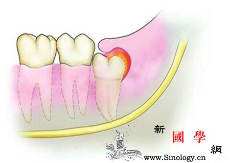 孕妇智齿发炎肿痛难忍怎么办学会这几招让你_肿痛-智齿-孕期-难忍-