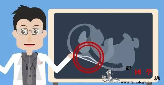 什么是NT检查：孕妈咪一定要懂的第一次胎儿排_还能-染色体-检出-胎儿-