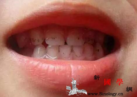 宝宝牙齿有黑点是怎么回事_龋齿-充填-蛀牙-牙科-