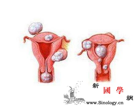 妊娠期间发现有子宫肌瘤该怎么办？_产道-肌瘤-妊娠-分娩-