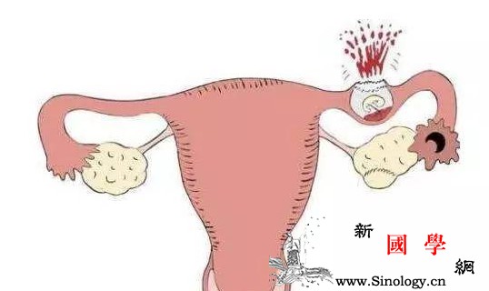 孕妇怀疑自己是宫外孕如何判断是不是？_宫外孕-抽血-腹痛-检查-