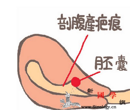 子宫疤痕妊娠有危险吗？什么是剖宫产后子宫疤痕_病灶-胚胎-植入-妊娠-