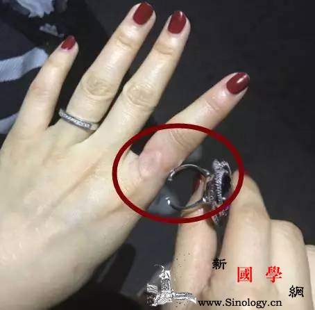 怀孕后一定要摘戒指吗？这位妈妈的惨痛经历告诉_水肿-孕期-戒指-盐分-