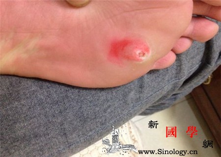 孕妇脚上长鸡眼怎么办这些方法让你远离它_橡皮膏-水杨酸-液氮-鸡眼-