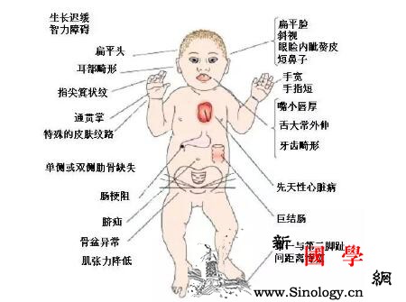 小儿唐氏综合症症状_嗜睡-伴有-综合症-喂养-