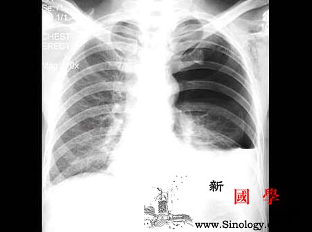 小儿慢性支气管炎的并发症_柱状-气急-支气管炎-支气管-