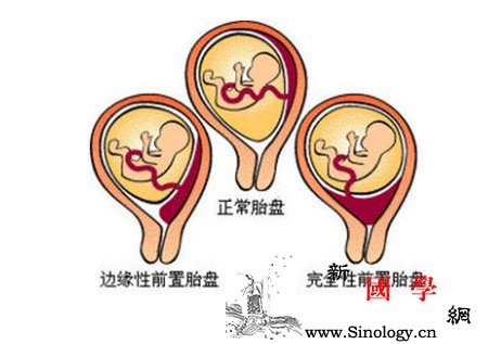 什么是前置胎盘？前置胎盘是怎样造成的？如何预_受精卵-胎动-胎盘-子宫-