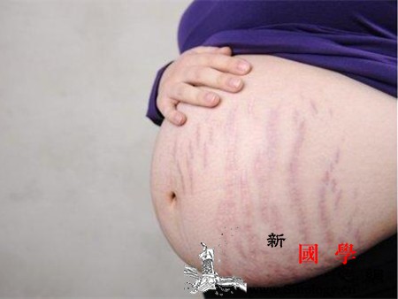 肥胖纹和妊娠纹有什么区别可从这四方面分辨_紫红色-臀部-肥胖-腹部-