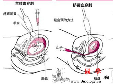 脐带血穿刺比羊水准吗_羊水-脐带-胎盘-穿刺-