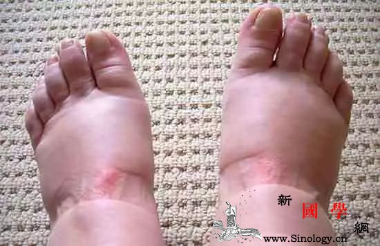 怀孕后期脚肿的像猪蹄这可咋办呀？_水肿-孕期-脚踝-组织液-
