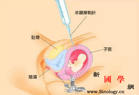 产科医生告诉你“羊水穿刺”背后的真相！_羊水-染色体-穿刺-胎儿-